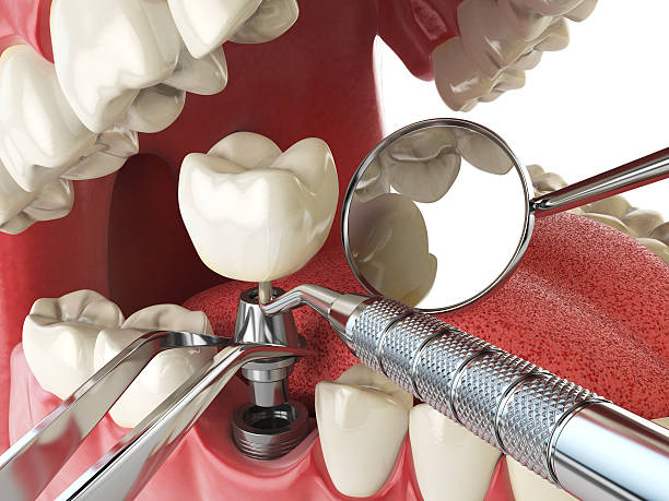 Best Emergency Root Canal Therapy in Fullerton, CA